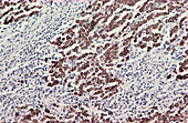 Lymph node cancer,light micrograph