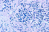 Ganglioneuroblastoma,light micrograph