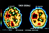 2 PET scans of axial section of brain with tumour