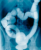 F/col Barium enema X-ray: colonic cancer