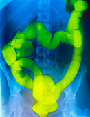 Barium enema X-ray showing cancer of the colon
