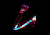 False-colour bone scan showing secondary cancer