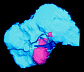 False-colour 3-D CT scan of liver cancer