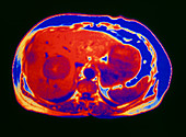 False-colour CT scan of liver cancer