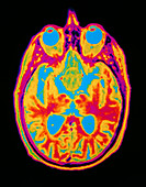 Coloured MRI brain scan: pituitary adenoma