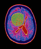CT scan showing a large brain tumour