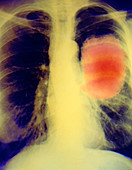 Colour X-ray image of lung cancer in left lung
