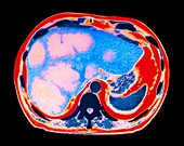 Coloured CT scan showing cancer of the liver