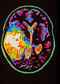 Colour MRI scan of brain tumour: oligodendroglioma