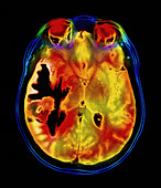 Coloured MRI scan of a metastatic brain tumour