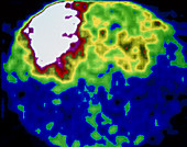 Coloured immunoscintigram of cancer of the colon