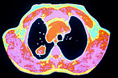 Coloured computed tomography scan of lung cancer