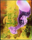 Coloured X-ray of stomach cancer (carcinoma)