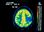Coloured PET scan of the brain showing a tumour