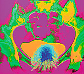 Conceptual coloured X-ray showing bladder cancer