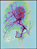 Coloured angiogram X-ray of a tumour in the liver