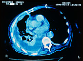 Mesothelioma lung cancer