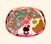 Liver cancer CT scan