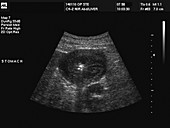 Stomach cancer,ultrasound