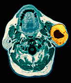 Salivary gland tumour,head MRI scan