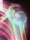 Bone marrow cancer,X-ray