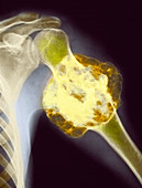 Upper arm tumour,X-ray