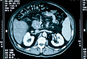 Pancreas cancer,CT scan