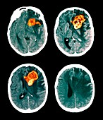 Brain cancer,CT scans