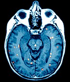 Brain cancers,MRI scan