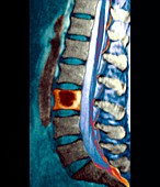 Bone cancer,spinal MRI scan