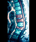 Bone cancer,spinal MRI scan