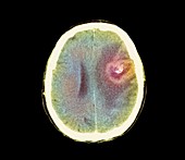 Astrocytoma brain cancer,CT scan