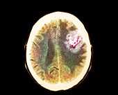 Astrocytoma brain cancer growth,CT scan