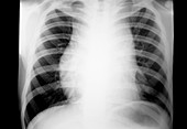 Hodgkin's disease,X-ray