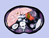 Metastatic pancreatic cancer,CT scan