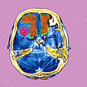 Secondary brain cancers,CT scan