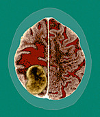 Secondary brain cancer,CT scan