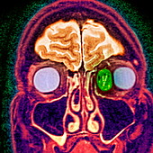 Secondary cancer,MRI