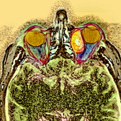 Secondary cancer,MRI