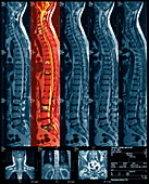 Bone cancer,MRI scan