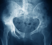 Secondary tumours,X-ray