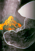 Stomach cancer,X-ray