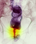 Narrowed rectum,X-ray