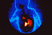 Neuroblastoma,gamma scan
