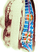 Secondary bone cancer,MRI scan