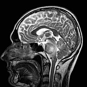 Brain tumour,MRI scan