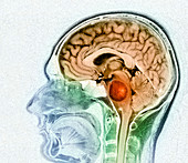 Brain tumour,MRI scan