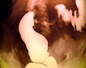 Colon cancer,barium X-ray