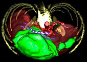 Primary liver cancer,3D MRI scan