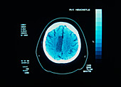 CT brain scan showing stroke (or CVA)